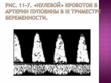 Кровоток в пуповине