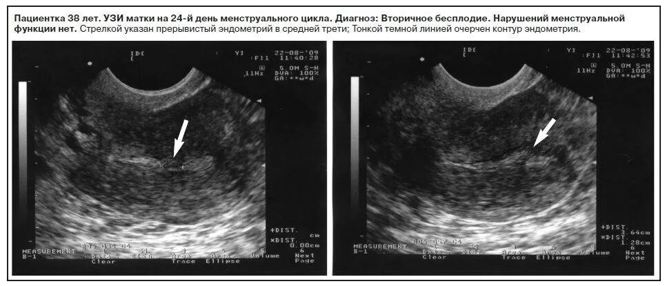 Полость матки 8. УЗИ нормального эндометрия. Эндометрия матки УЗИ гиперплазия эндометрия. Эндометрий на УЗИ норма.