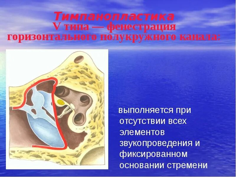 Тимпанопластика отзывы. Фенестрация полукружного канала. Тимпанопластика уха 1 типа. Операция тимпанопластика.