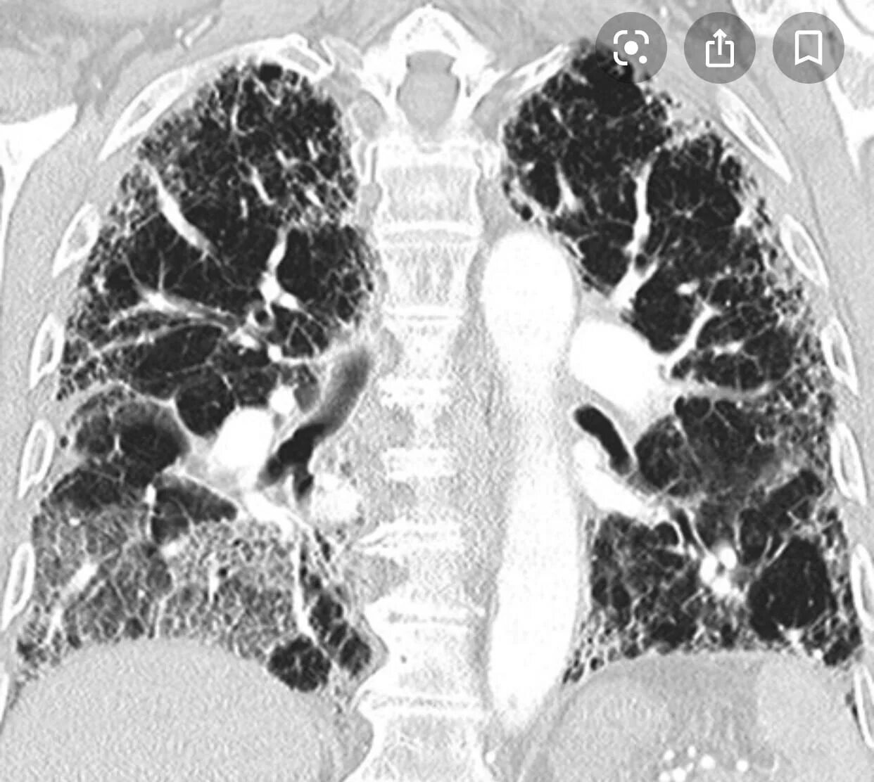 Диффузный пневмосклероз это рак. Идиопатический пневмофиброз. Идиопатический фиброзирующий альвеолит кт. Диффузный пневмофиброз кт.