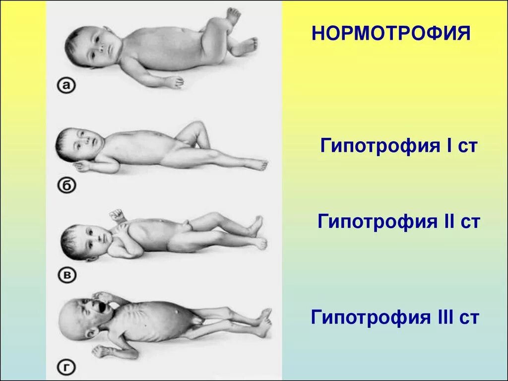 Дефицит веса у ребенка