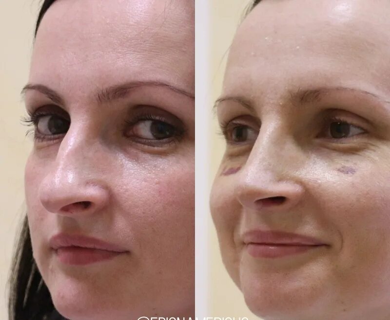 Практика пластического хирурга тумакова г и. Тумаков ринопластика инстаграм. Стайсупов ринопластика до и после. Эпиона медикус пластика носа. Практика пластического хирурга тумакова г и.