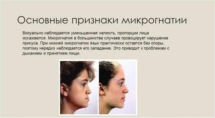 Недоразвитая нижняя челюсть у ребенка. Макрогнатия верхней челюсти. Почему дрожит нижняя челюсть. Гимнастика для дистального прикуса. Почему дрожит нижняя челюсть.