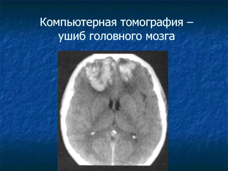 Мрт при сотрясении. Ушиб головного мозга кт мрт. Рентген головного мозга при сотрясении. Снимок мрт головы с гематомой.