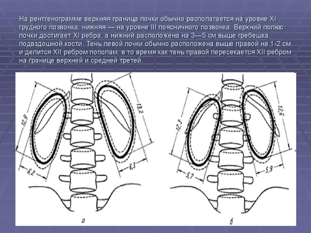 1 3 на верхнем уровне. Почки расположены на уровне l1-l3. Верхние границы почек. Почки расположены на уровне позвонков. Уровень расположения почек.