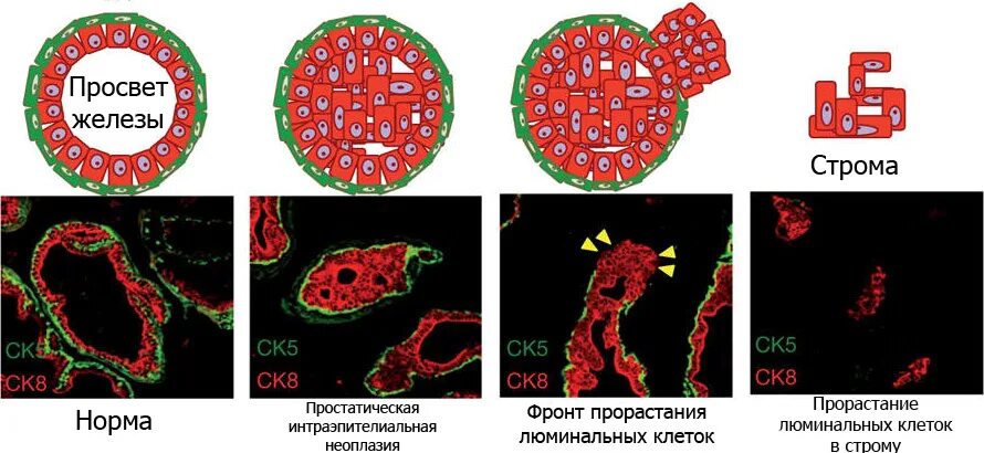 Люминальный тип а рака молочной прогноз. Люминальные клетки. люминальный тип опухоли молочной железы. люминальный эпителий молочной железы. люминальные и базальные клетки молочной железы.