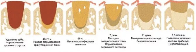 Обработка раны после удаления зуба и уход за ней
