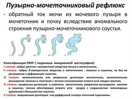 Заброс мочи в почки