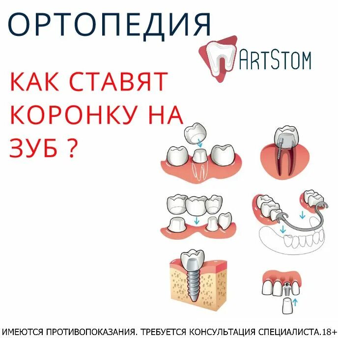Как одевается коронка на зуб Foto-Leto.ru