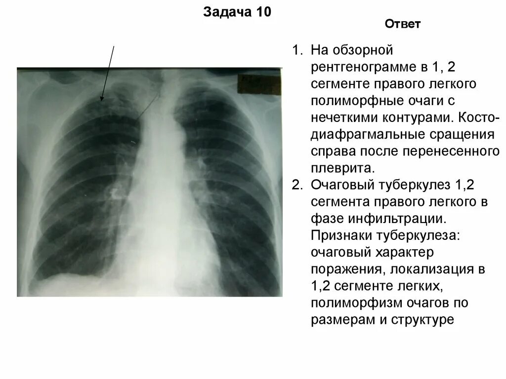 Очаги в нижней доле легкого. Кальцинат s3 правого легкого это. Кальцинаты туберкулеза рентген. Кальцинаты в легких рентген. Множественные кальцинаты в легких рентген.