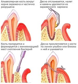 Десневой карман