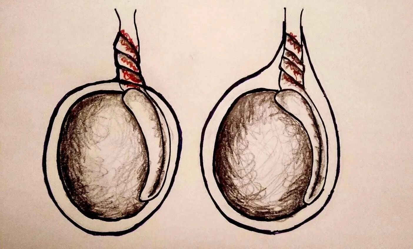 Опухли яйца у мужчины причины. Перекручивание гидатиды яичка.
