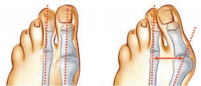 Вальгус косточка на большом пальце. Вальгус деформация большого пальца стопы. Плоскостопие вальгусная стопа операция. Вальгусная деформация косточки. Операция на стопы обувь