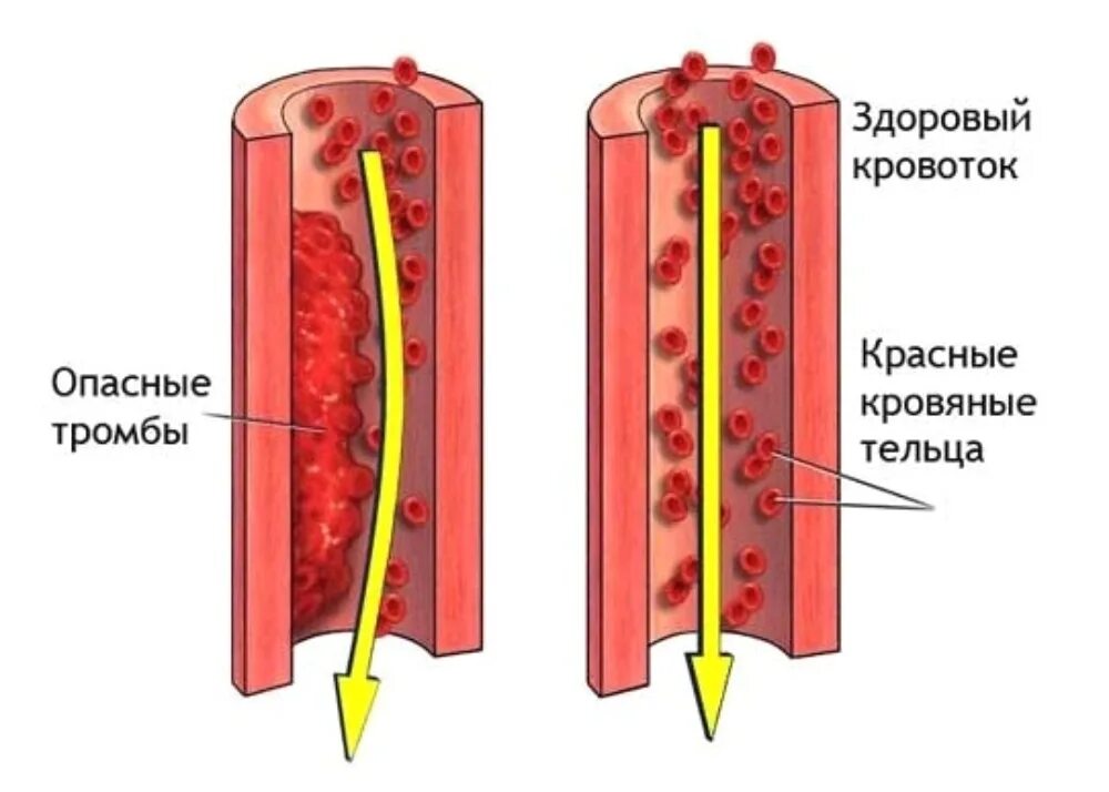 Образование тромба в сосуде. Профилактика тромбообразования. Профилактика тромбов в сосудах. Чтоб не было тромбы