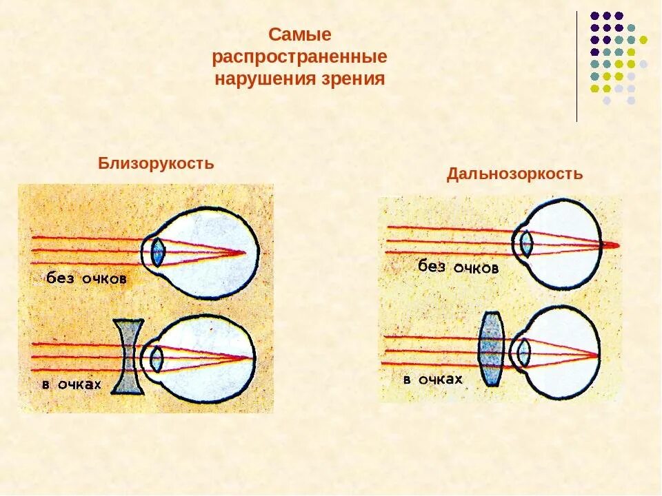 Причины возникновения дальнозоркости. Причины нарушения зрения близорукость дальнозоркость. Нарушения зрения подростка: близорукость и дальнозоркость. Таблица заболевания глаз близорукость и дальнозоркость. Таблица нарушение зрения близорукость дальнозоркость.