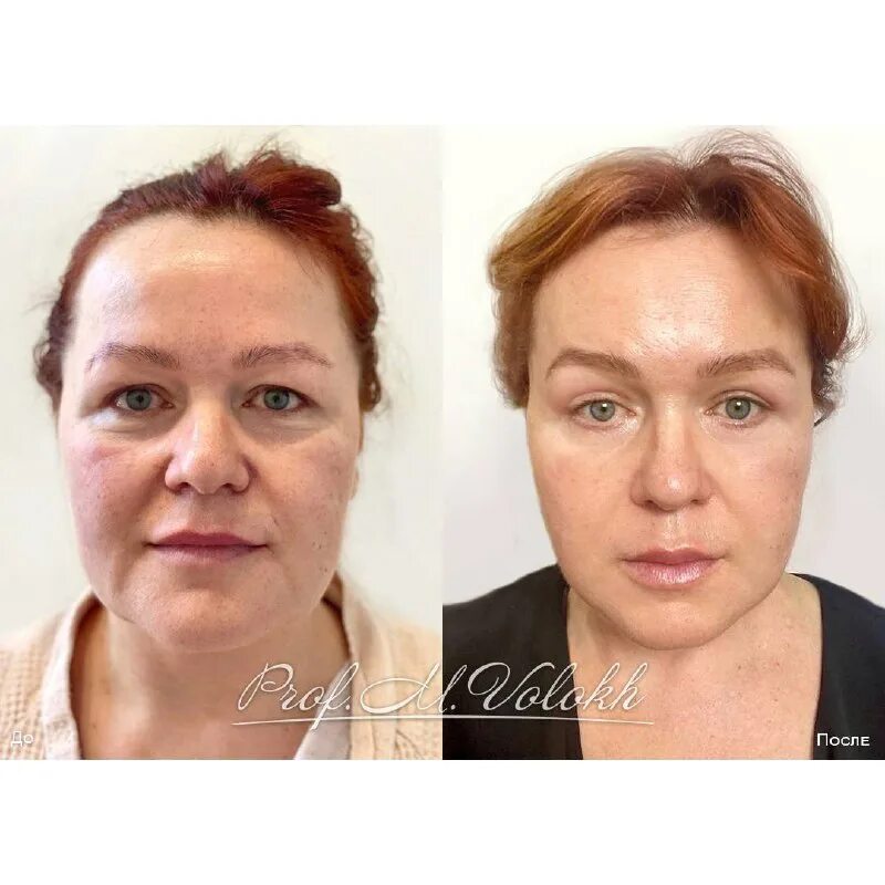 массаж от нависшего века. задачи эндокринологии. пациентка 38 лет. реоформинг. смас лифтинг эффект.