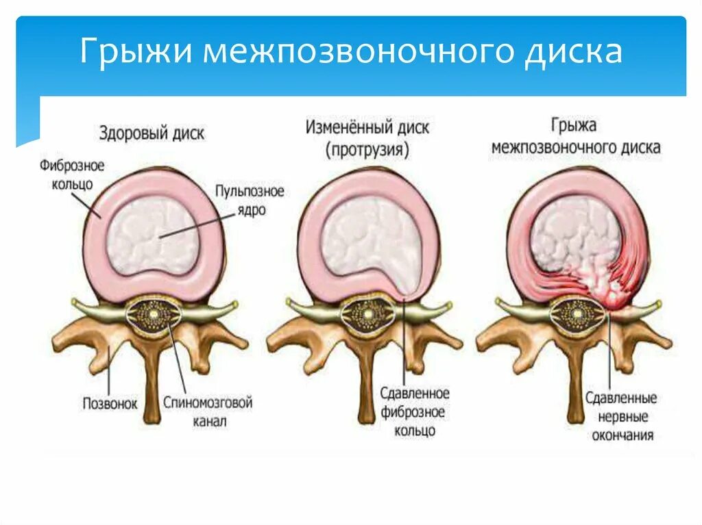 Типы грыж диска. Протрузия грыжа межпозвонковых дисков. Фораминальная экструзия межпозвонкового диска l 5 s 1. Задняя парамедианная протрузия диска.