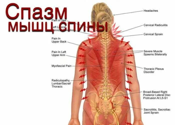 Снять спазм грудного отдела. Спазмы в спине. спазмированные мышцы. спазм мышц позвоночника. мышечный спазм в спине.