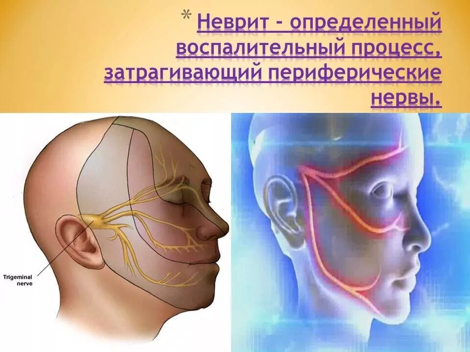 Левый лицевой нерв. Воспаление тройничного лицевого нерва. Тройничный лицевой нерв. Невралгия тройничного нерва. Неврите лицевого нерва. Неврит воспаление нерва.