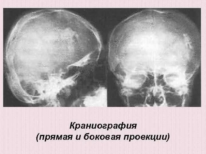 Обызвествление в проекции