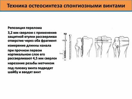 Остеосинтез классификация