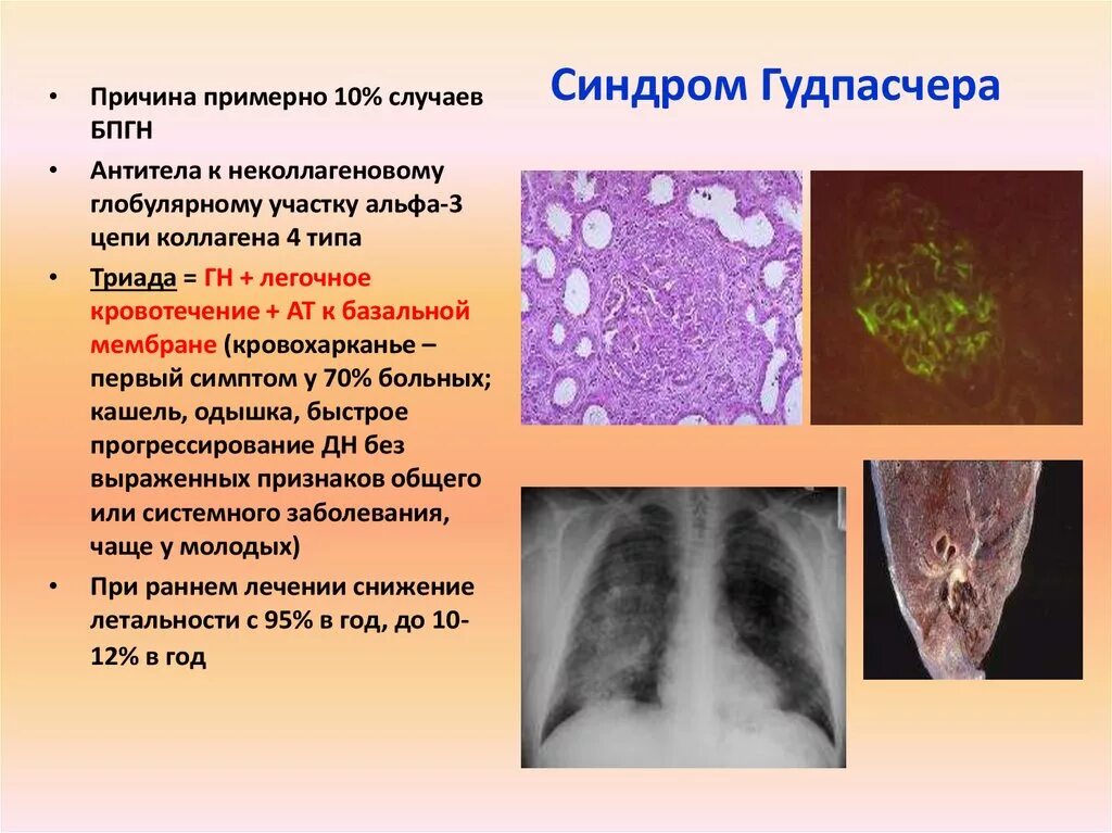 Синдром гудпасчера это. Синдром гудпасчера презентация. синдром гудпасчера этиология.