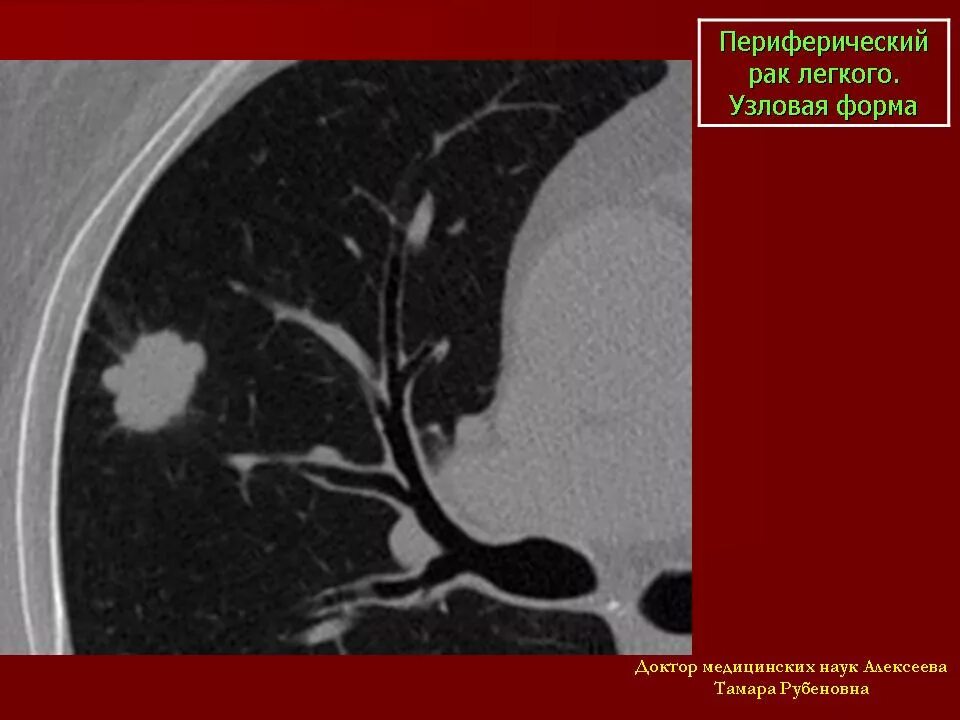 Периферическое объемное образование на кт. • Пневмониеподобная форма периферического. Узловые образования в легких на кт. Узловое периферическое образование легкого на кт. Признаки периферического легкого