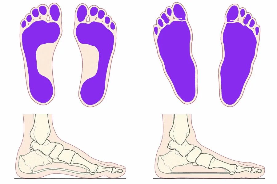 Нога имеет плоскую ползательную подошву. Нормальная стопа и плоскостопие. Стопа здорового человека и плоскостопие. Стопа анатомия плоскостопие. Стопа нормального человека и плоскостопие.