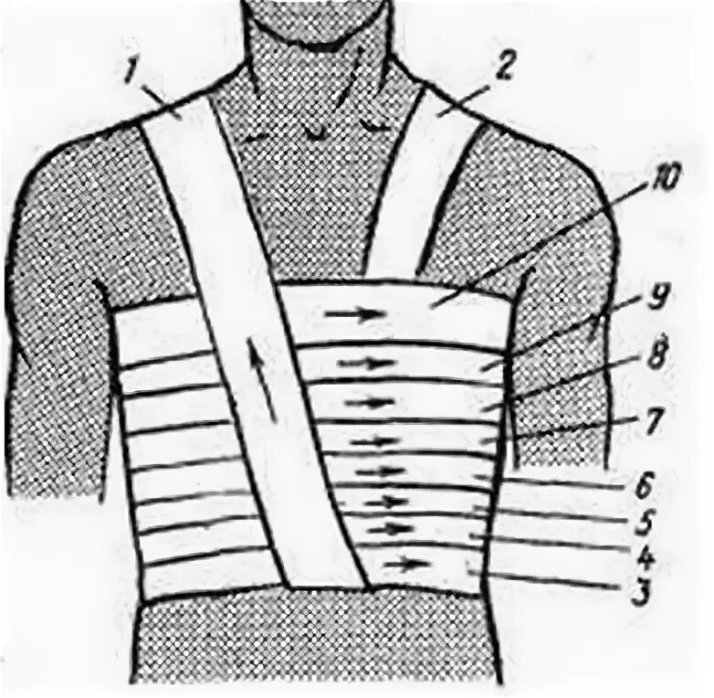 Повязка на грудную клетку алгоритм. Спиральная перевязка грудной клетки. Десмургия спиральная повязка на грудь. Перелом ребер бинтование. Наложение спиралевидной повязки на грудную клетку.