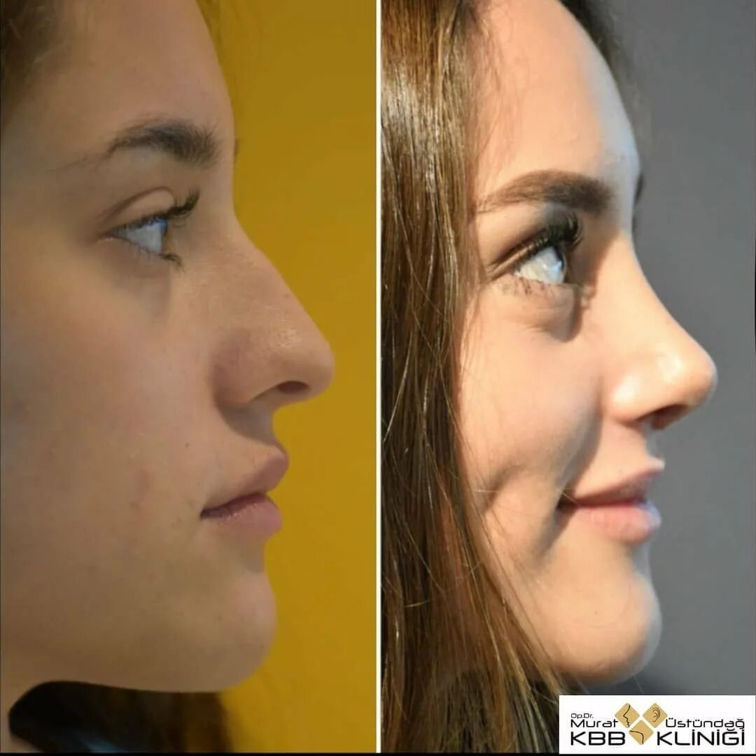 Инъекционная ринопластика. Ринопластика до и после. Пластика носа до и после. Ринопластика красивый нос.