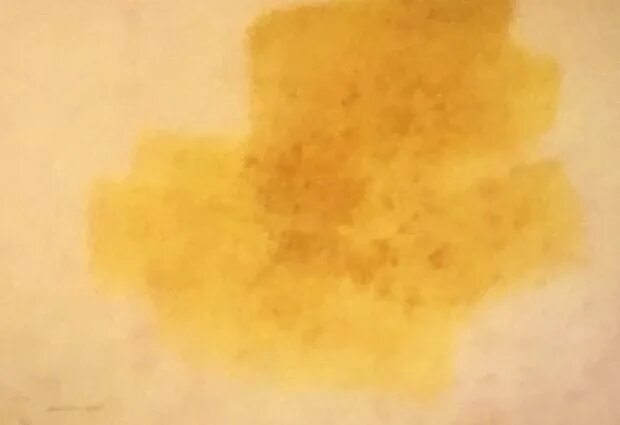 Выступает йод на ладонях. Отрубевидный лишай йод. Тест с йодом. Пятна цвета йода. Разлитый йод.