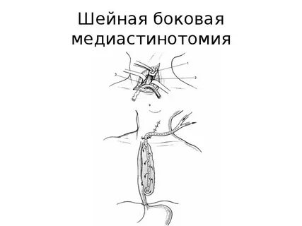Медиастинит пищевода