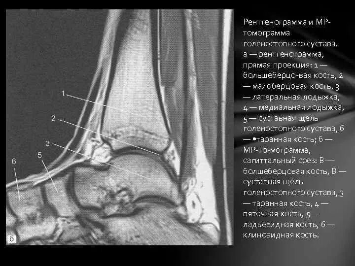 Голеностопный сустав рентген анатомия. Суставная щель голеностопного сустава рентген. Голеностопный сустав мрт анатомия голеностопный. Суставная щель голеностопного сустава норма.