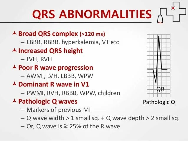 Qrs m 30. Qrs m 30