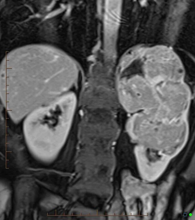 Гепатоцеллюлярная аденома печени мрт. Фиброламеллярная карцинома печени мрт. Гиперваскулярные метастазы печени кт. Опухоли контраст. Опухоли контраст.