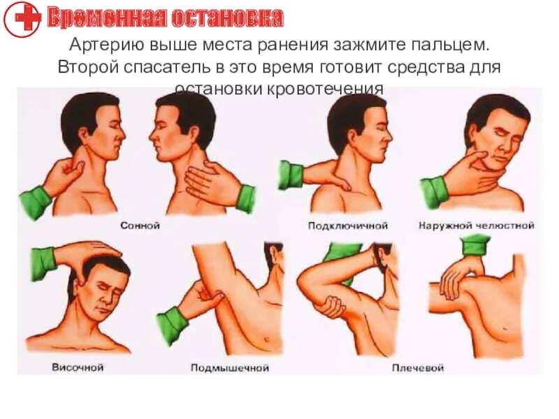 Пальцевое прижатие сонной артерии при ранении. Методы остановки кровотечения сонной артерии. Остановка артериального кровотечения сонной артерии. Метод остановки кровотечения сонной артерии.