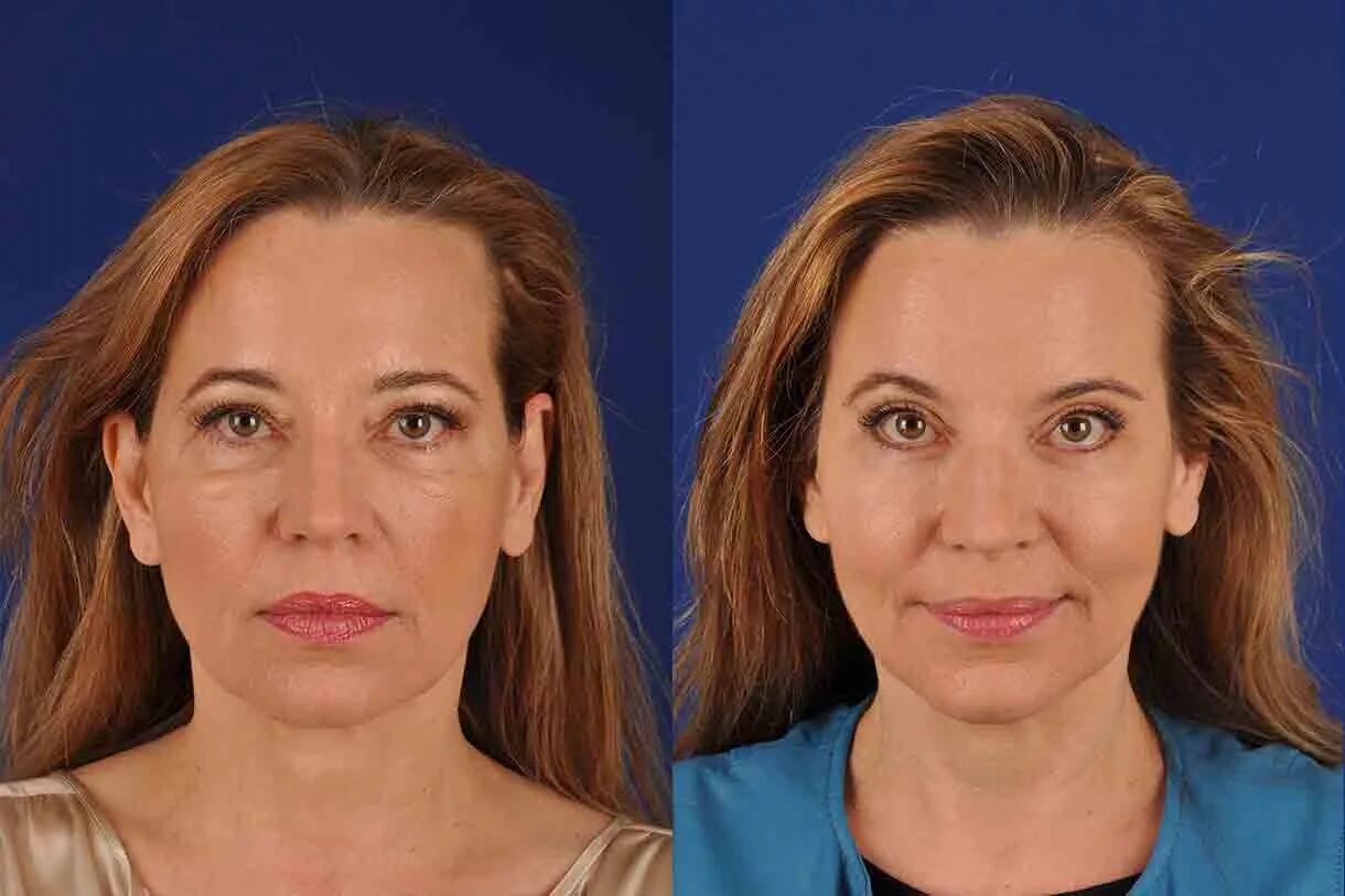 Броулифт. Подтяжка лба и бровей. Brow lifting