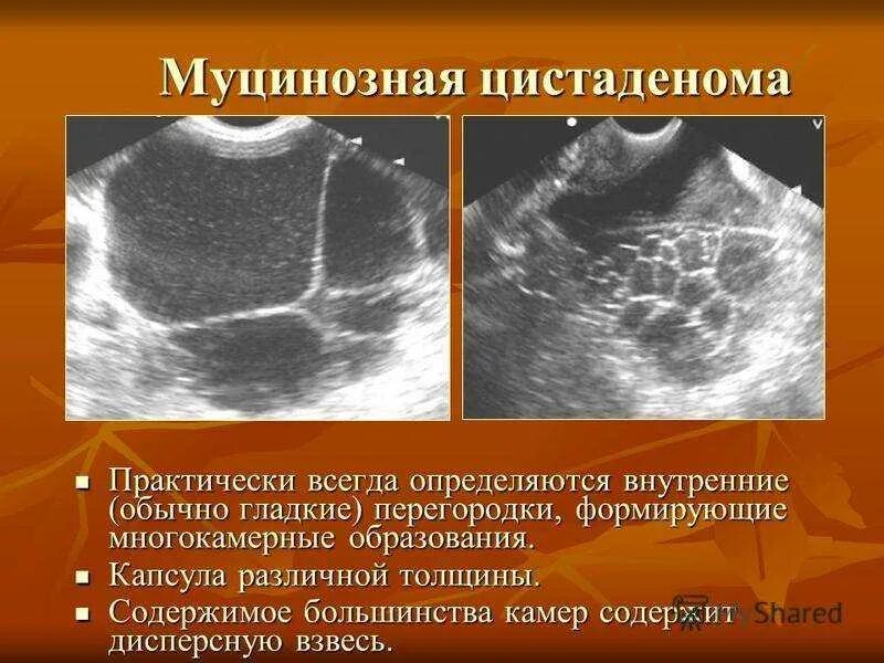 Эхо признаки кисты