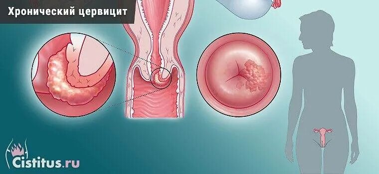 Хронический эндоцервицит что это. Цервицит и эндоцервицит. Хронический цервицит шейки. Гонорейный эндоцервицит.