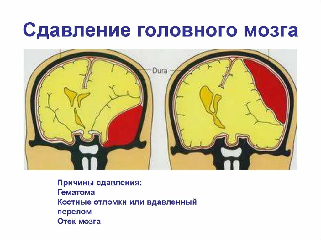 Травматических повреждений мозга. Травматическая компрессия головного мозга. Сдавление головного мозга. Давление головного мозга. Сдавление головного мозга гематомой.