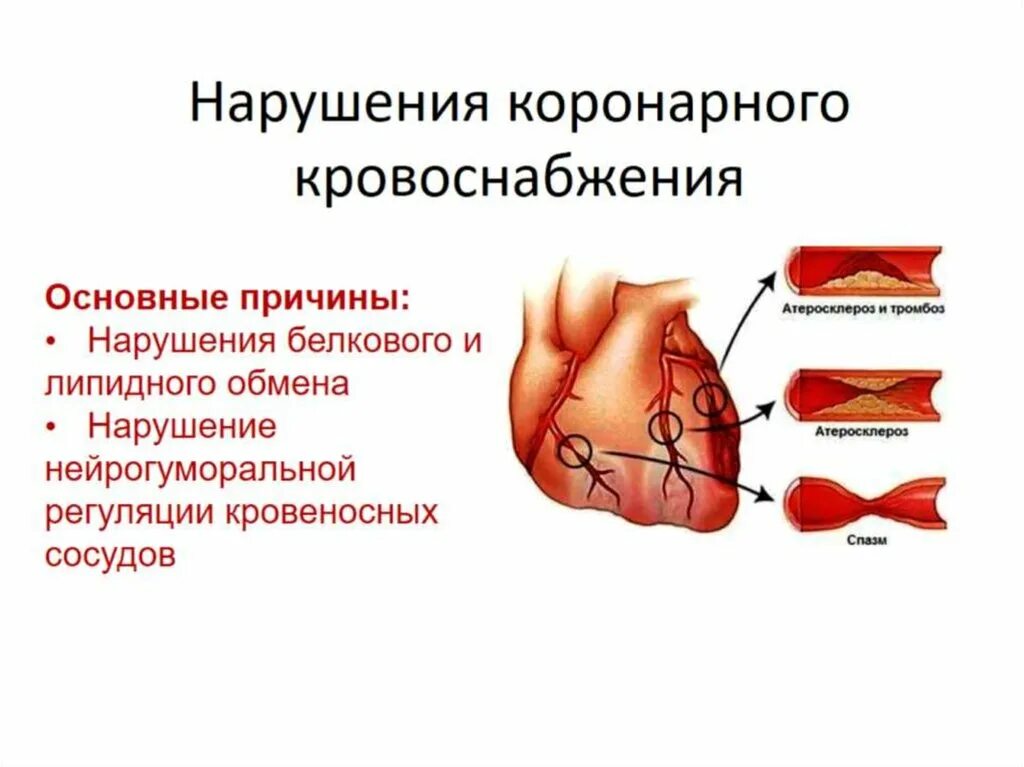 Патофизиологические механизмы нарушения коронарного кровообращения. Следствие нарушения кровотока в коронарных артериях. Причины нарушения коронарного кровообращения. Причины нарушения коронарного кровотока. Нарушение кровообращения механизмы