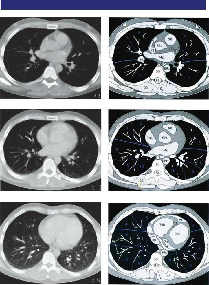 Доли легкого на кт. Сегменты легких кт Хофер. Сегменты легких кт Radiology 24. Кт сегменты легких на кт. Кт грудной клетки Хофер.