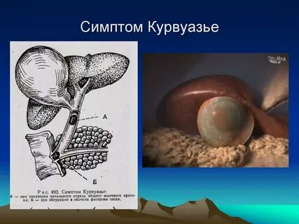 Симптом курвуазье
