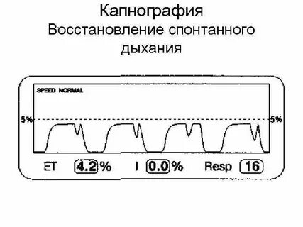 Капнография