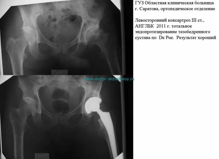 Коксартроз тазобедренного сустава рентген. Диспластический коксартроз тазобедренного сустава рентген. Диспластический коксартроз тазобедренного сустава у детей. Левосторонний диспластический коксартроз. Коксартроз к какому врачу обратиться