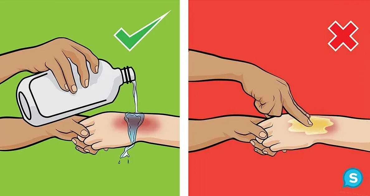 Оказание пмп при термических ожогах. При термическом ожоге кожи необходимо. При оказании помощи при ожогах нельзя. При термическом ожоге при оказании первой помощи необходимо. Правила первой помощи при ожогах.