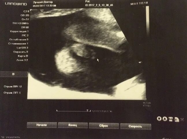 Пол ребенка на втором скрининге. Могут ли ошибиться с полом форум. Узи пола ребенка мальчик. Могут ли ошибиться с полом форум. Пол ребёнка на узи в 12.