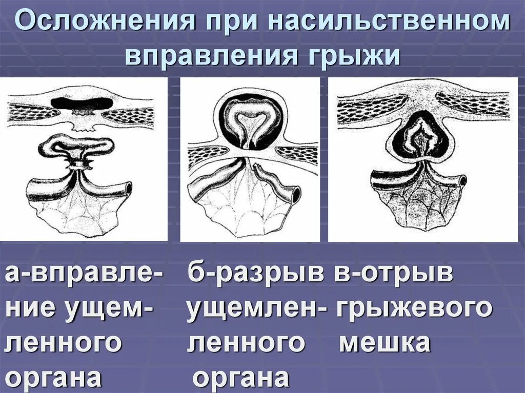 Вправление ущемленной грыжи. Мнимое вправление ущемленной грыжи. Осложнения при насильственном вправлении грыжи. Ущемление грыжи вправлять. Ложное вправление ущемленной грыжи.