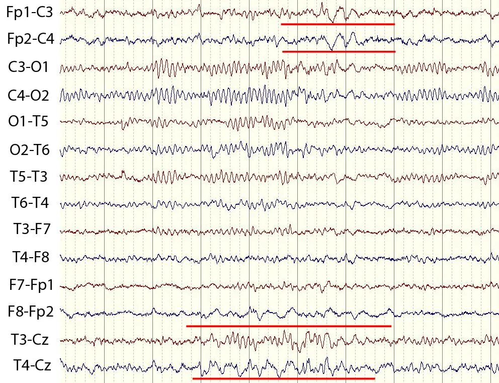 Острая-медленная волна на ЭЭГ. Дельта активность на ЭЭГ. ЭЭГ эпилепсия пик-волна. Пик волна на ЭЭГ. Спайк на ээг