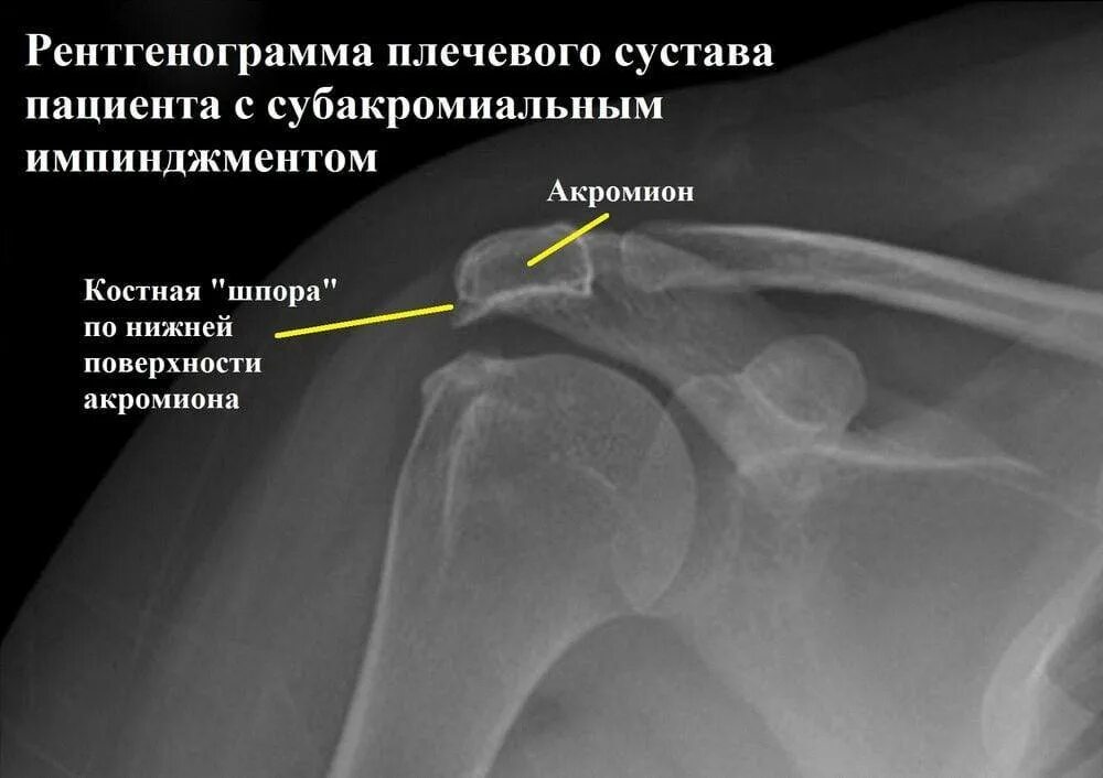 Синдром сдавления ротатора плеча. Импиджмент плечевого сустава рентген. импиджмент синдром плечевого сустава рентген. импинджмент синдром рентген. субакромиальный бурсит плечевого сустава рентген.